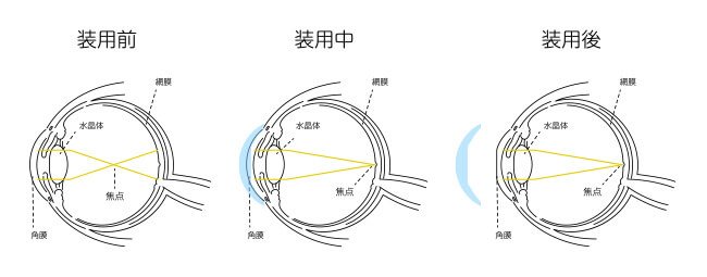 オルソケラトロジーのイメージ
